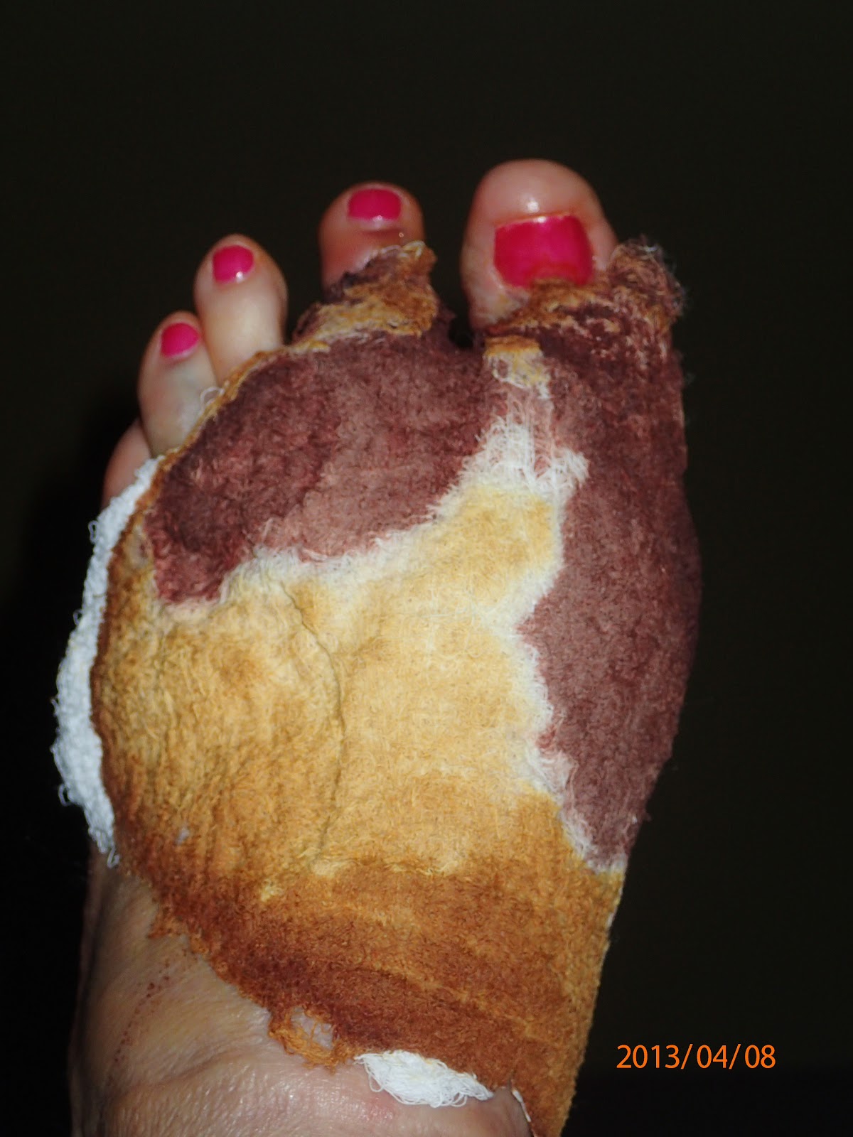 What should you expect after hammertoe surgery?